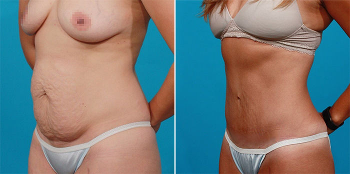 Пациентка доктора Гукаса Миракяна до и после абдоминопластики