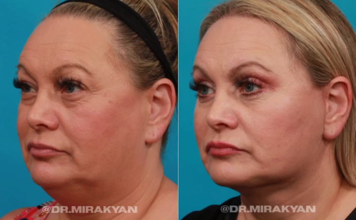 Пациентка пластического хирурга Гукаса Миракяна до и после омоложения. Женщине выполнена подтяжка лица и круговая блефаропластика