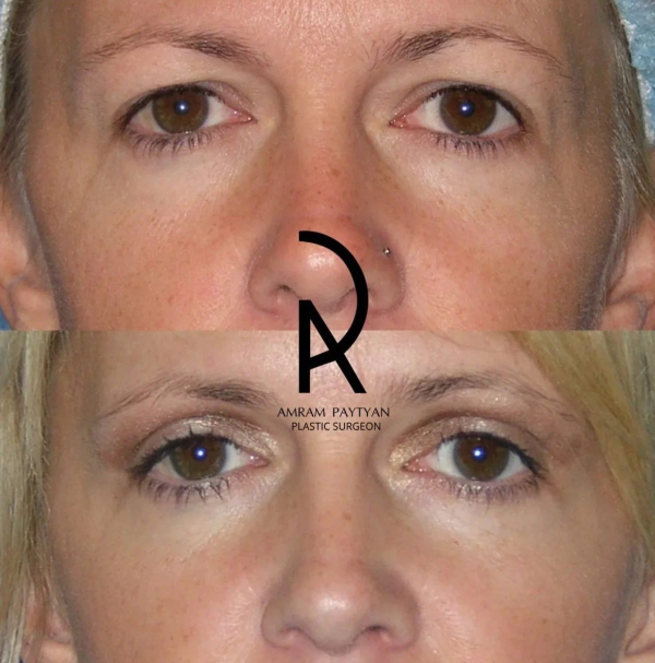 Фото пациентки пластического хирурга Амрама Пайтяна до и после блефаропластики век