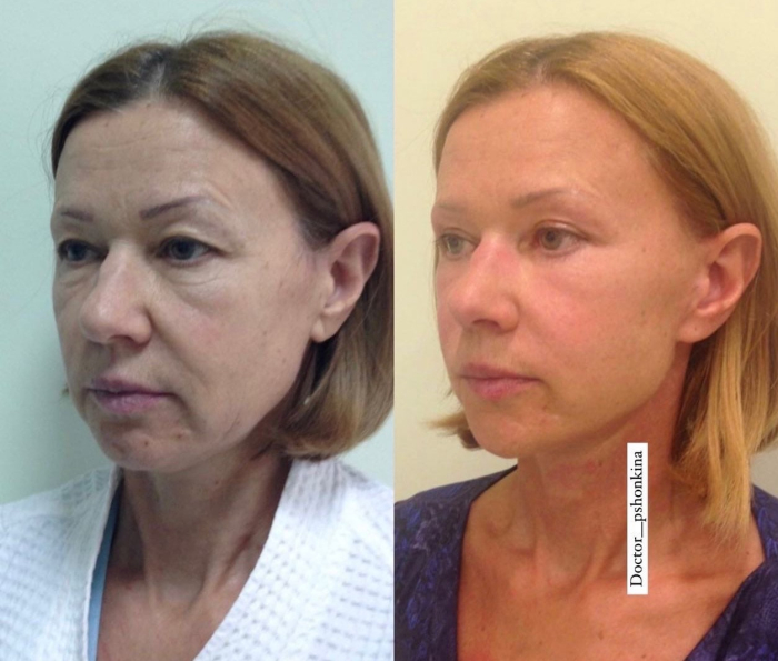 Пациентка доктора Светланы Пшонкиной до и после омолаживающей операции Смас-лифтинг на лице