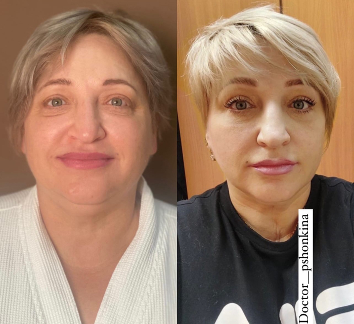 Пациентка хирурга Светланы Пшонкиной до и после омолаживающей операции на лице.
