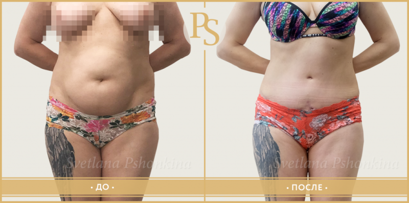 Пациентка пластического хирурга Светланы Пшонкиной до и после комплексной операции по моделированию фигуры Боди Силуэт.