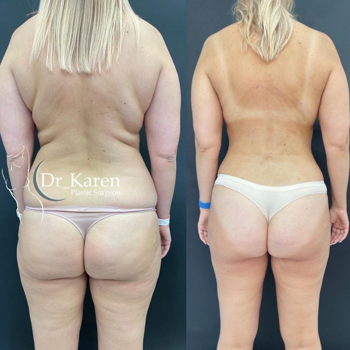 Пациентка доктора Карена Пайтяна до и после липомоделирования тела.