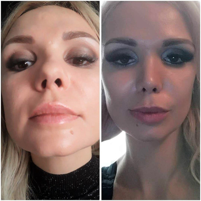 Пациентка доктора Карена Пайтяна до и после риносептопластики