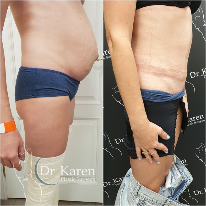 Пациентка доктора Карена Пайтяна до и после подтяжки живота