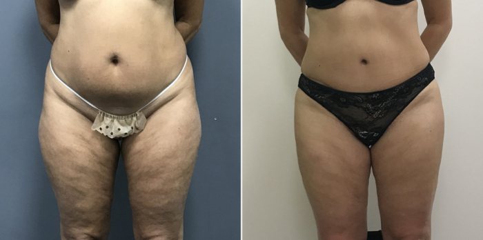 Пациентка доктора Дмитрия Рябцева до и после абдоминопластики