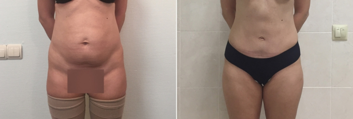 Пациентка доктора Дмитрия Рябцева до и после абдоминопластики