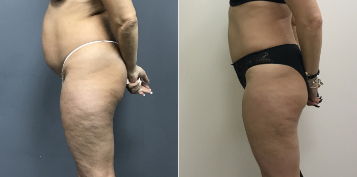 Пациентка доктора Дмитрия Рябцева до и после абдоминопластики