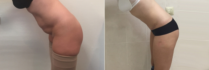 Пациентка доктора Дмитрия Рябцева до и после абдоминопластики