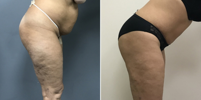 Пациентка доктора Дмитрия Рябцева до и после абдоминопластики