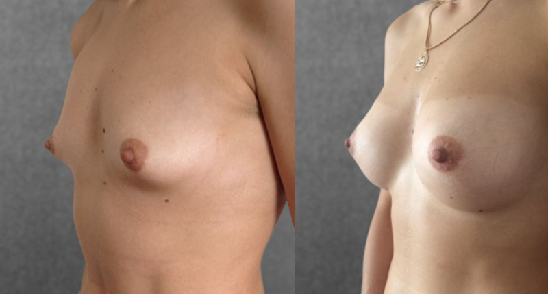 Пациентка пластического хирурга Дмитрия Крысина до и после увеличения груди имплантами