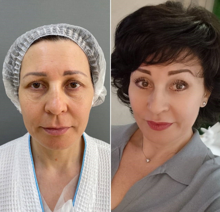 Пациентка пластического хирурга Марины Четвериковой до и после омоложения лица и век