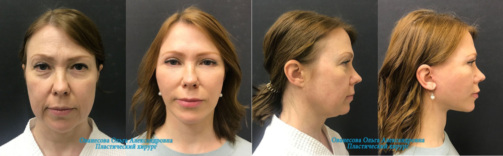 Пациентка пластического хирурга Ольги Ованесовой до и после комплексной омолаживающей операции