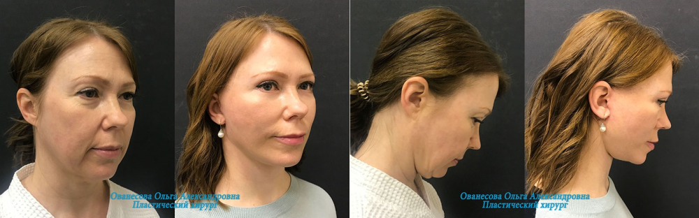 Пациентка пластического хирурга Ольги Ованесовой до и после комплексной подтяжки лица и шеи