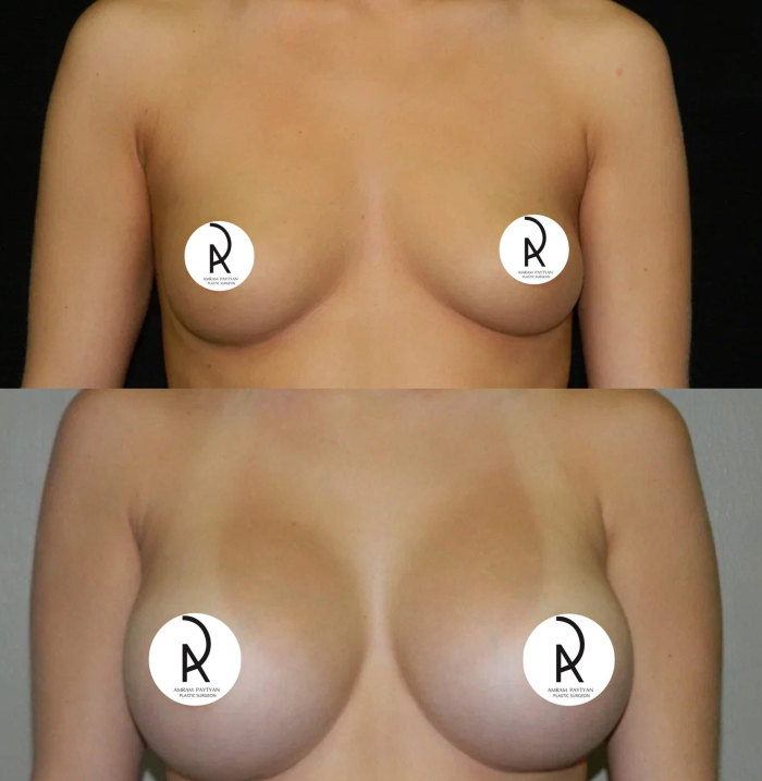 Пациентка пластического хирурга Амрама Пайтяна до и после увеличения груди силиконовыми имплантами