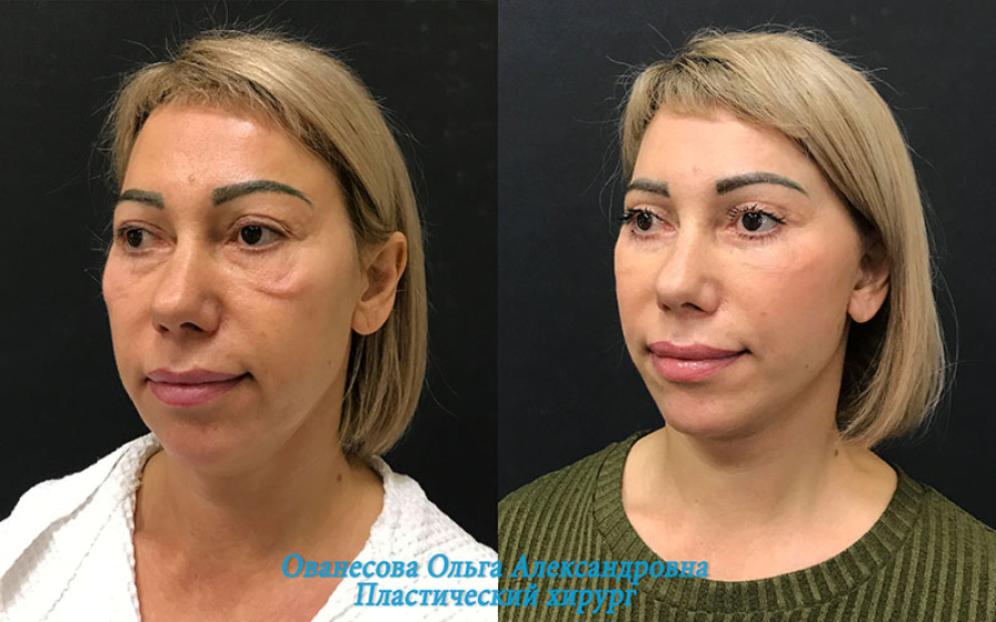 Пациентка пластического хирурга Ольги Ованесовой до и после удаления малярных мешков и комплексного омоложения лица и шеи