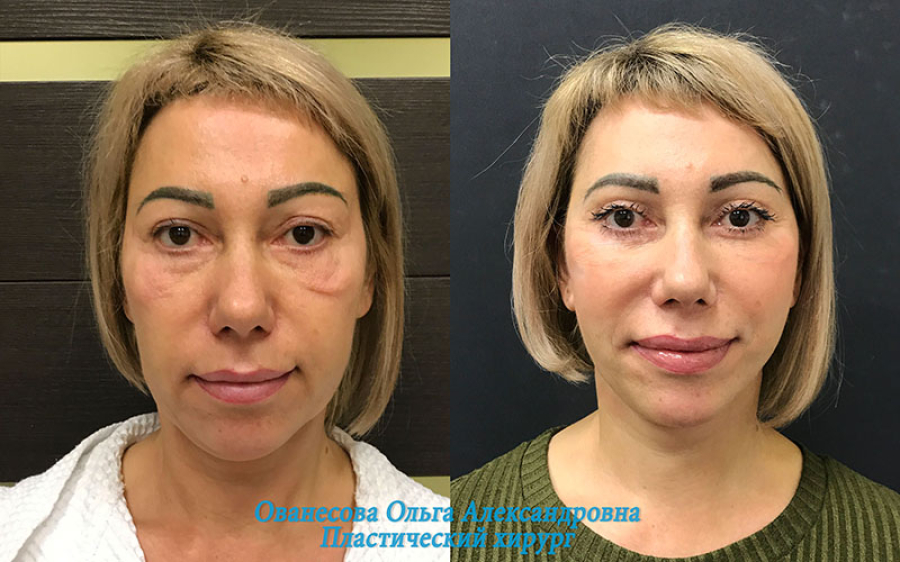 Пациентка пластического хирурга Ольги Ованесовой до и после удаления малярных мешков и комплексного омоложения лица и шеи