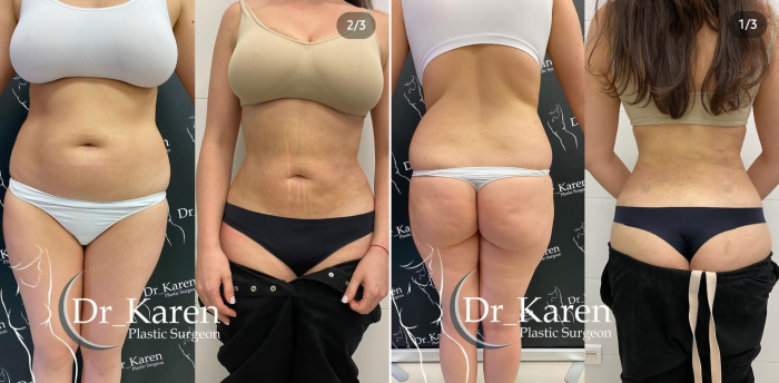Пациентка пластического хирурга Карена Пайтяна до и после круговой липосакции тела