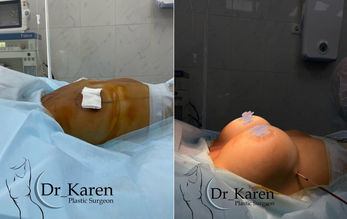 Пациентка пластического хирурга Карена Пайтяна до и после маммопластики