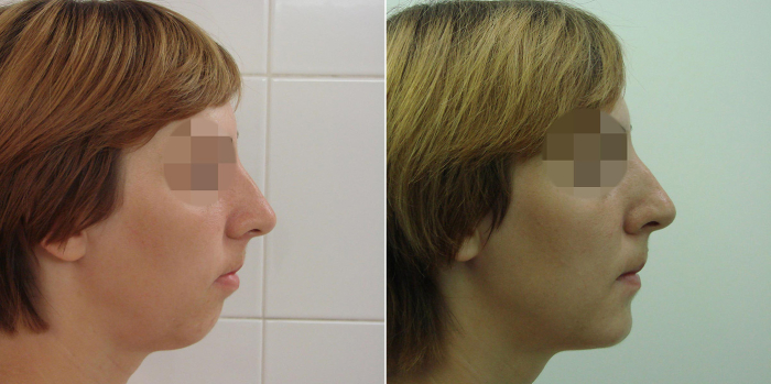 Пациентка доктора В. Стайсупова до и после увеличения подбородка имплантом