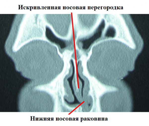 КТ пазух настоящего пациента с искривленной носовой перегородкой