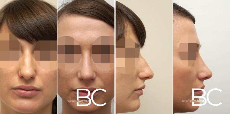 Пациентка пластического хирурга Валерия Стайсупова до и после закрытой септоринопластики.