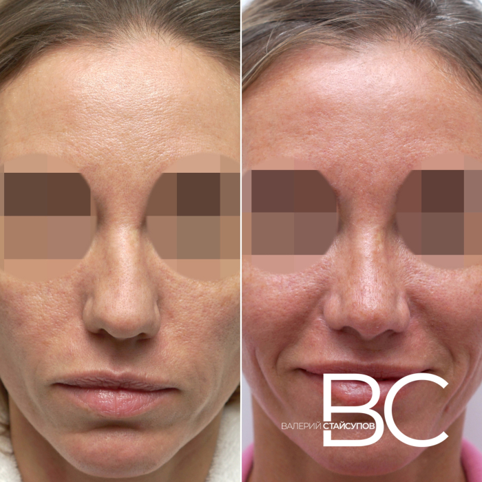 Пациентка пластического хирурга Валерия Стайсупова до и после закрытой ринопластики