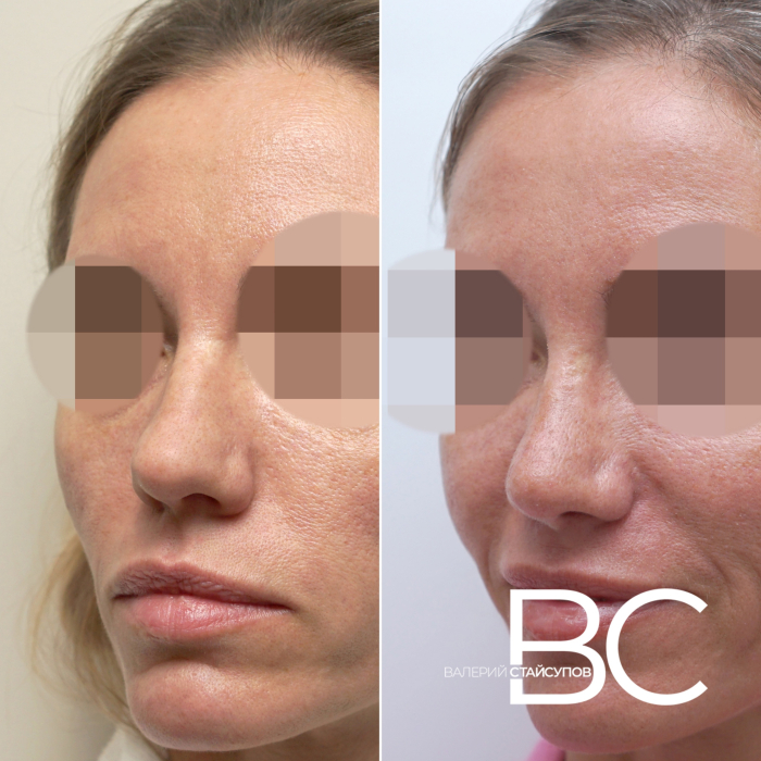 Пациентка пластического хирурга Валерия Стайсупова до и после закрытой ринопластики