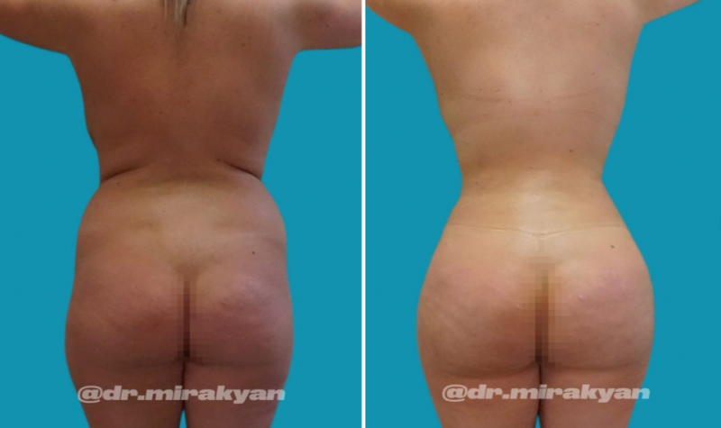 Пациентка пластического хирурга Гукаса Миракяна до и после увеличения ягодиц путем липофилинга