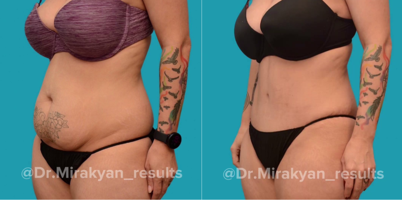 Пациентка пластического хирурга Гукаса Миракяна. Фото до и после операции по подтяжке живота