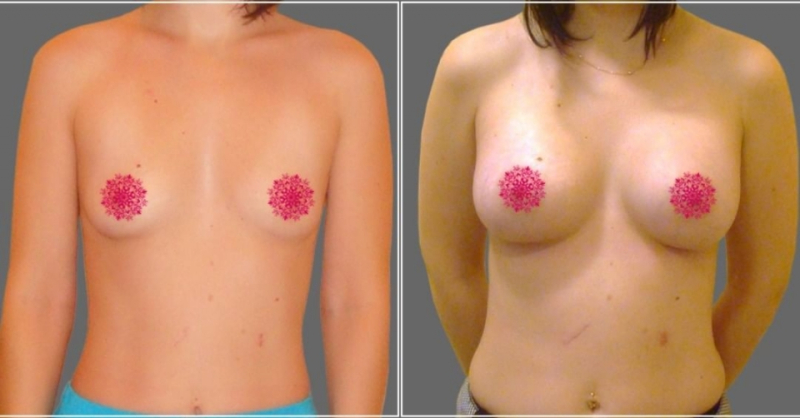 Пациентка доктора Д.А. Рябцева до и после увеличения груди