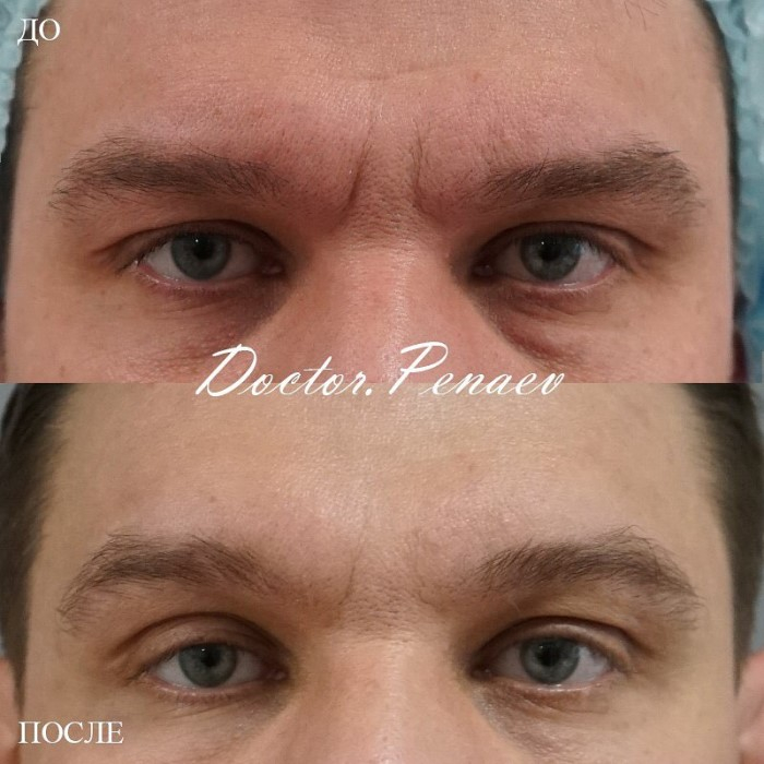 Пациент пластического хирурга Аслана Пенаева до и после авторской процедуры Вечный Ботокс