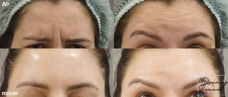 Пациентка пластического хирурга Аслана Пенаева до и после ботокса