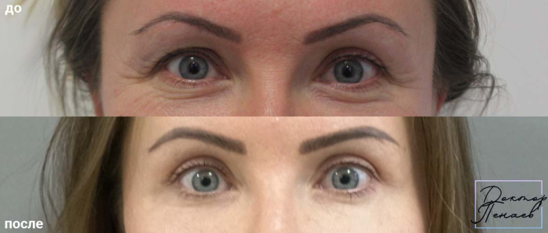 Пациентка пластического хирурга Аслана Пенаева до и после блефаропластики верхних век