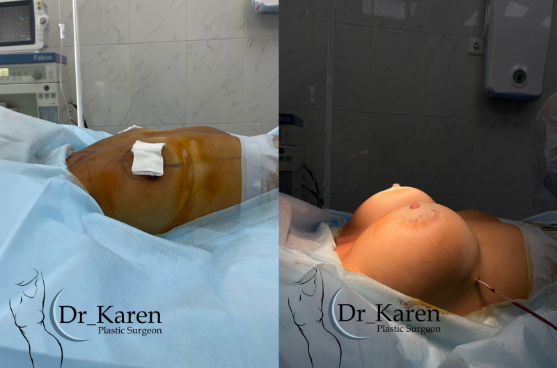 Пациентка пластического хирурга Карена Пайтяна. Женщине выполнено увеличение груди с подтяжкой вокруг ареол