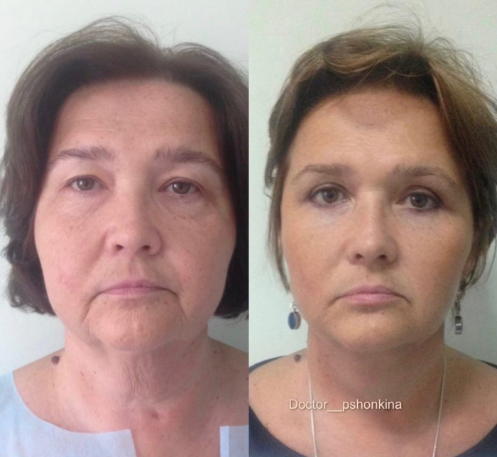 Пациентка пластического хирурга Светланы Пшонкиной до и после подтяжки лица и пластики век