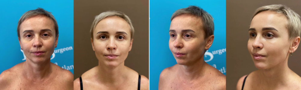 Пациентка пластического хирурга Светланы Пшонкиной. Фото до и после эндоскопического лифтинга лица