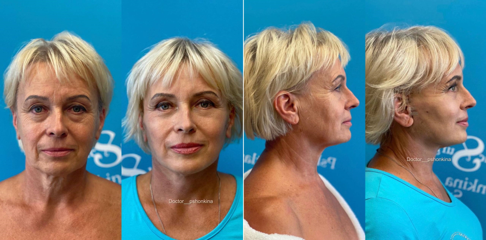 Пациентка пластического хирурга Светланы Пшонкиной. Фото до и после СМАС-лифтинга лица