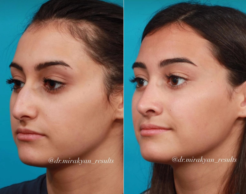 Фото пациентки до и после ринопластики. Оперирующий хирург – доктор Гукас Миракян