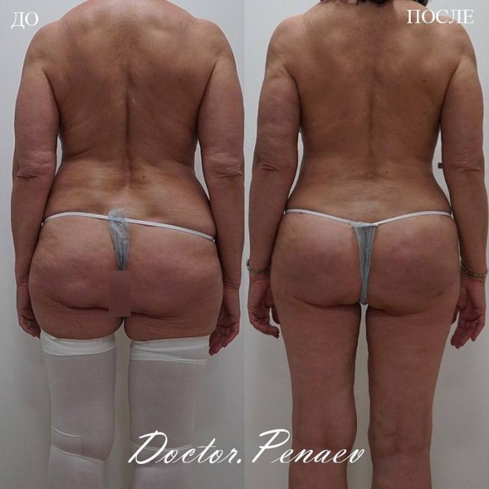 Липотрансфер ягодиц