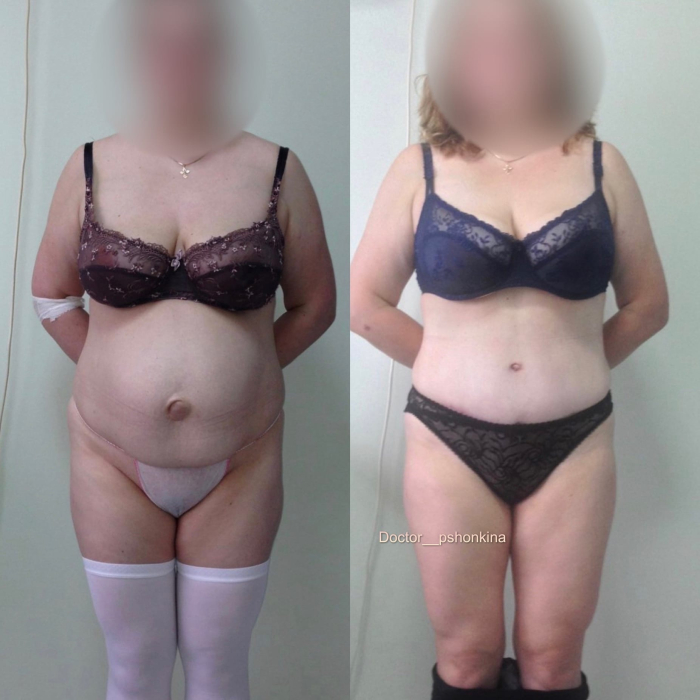 Пациентка пластического хирурга Светланы Пшонкиной до и после абдоминопластики и грыжесечения