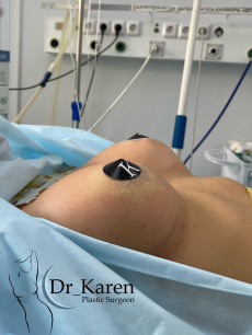 Пациентка пластического хирурга Карена Пайтяна. Женщине выполнено увеличение груди