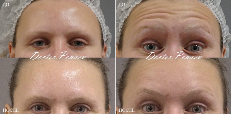 Пациентка доктора Арслана Пенаева до и после процедуры Вечный ботокс