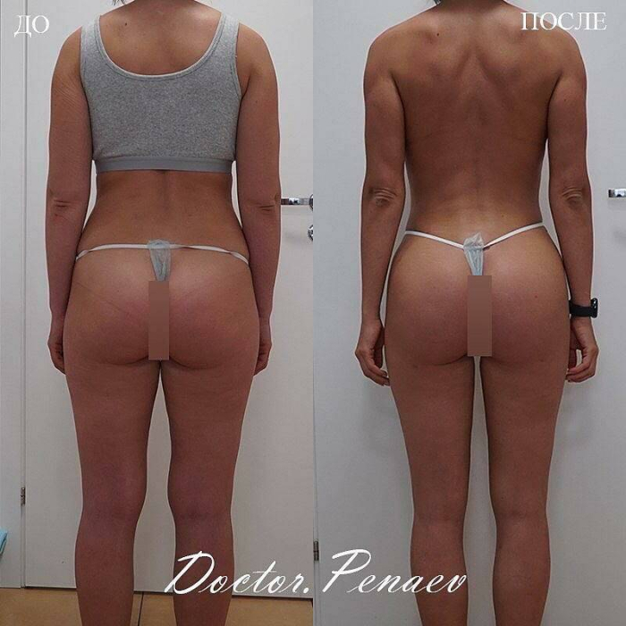 Липотрансфер ягодиц