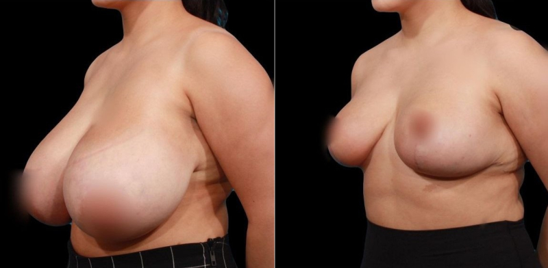 Пациентка пластического хирурга Гукаса Миракяна. Фото до и после уменьшения груди