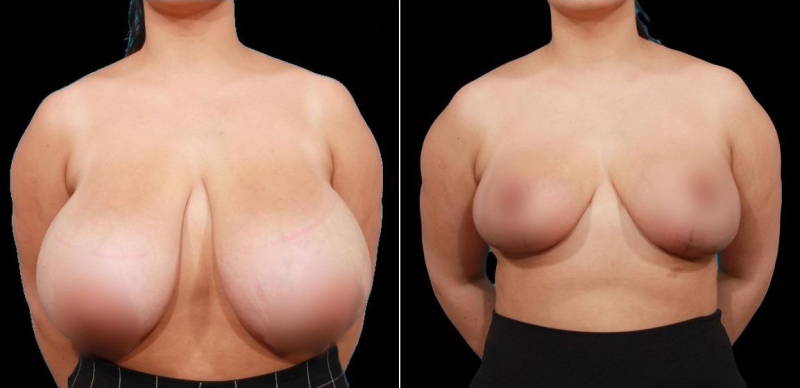 Пациентка пластического хирурга Гукаса Миракяна. Фото до и после уменьшения груди