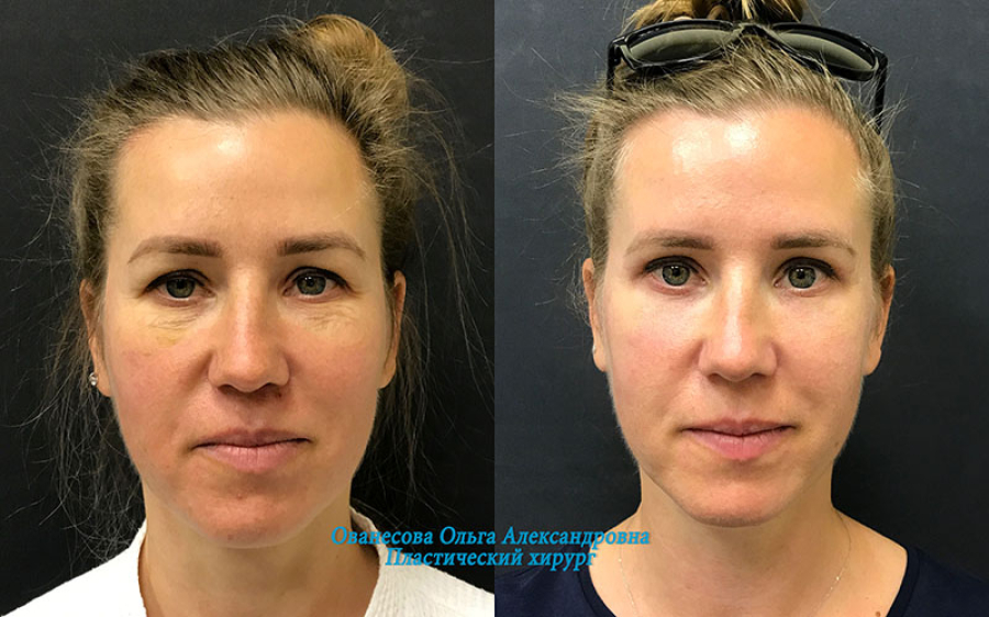 Пациентка пластического хирурга Ольги Ованесовой до и после удаления малярных мешков и круговой блефаропластики