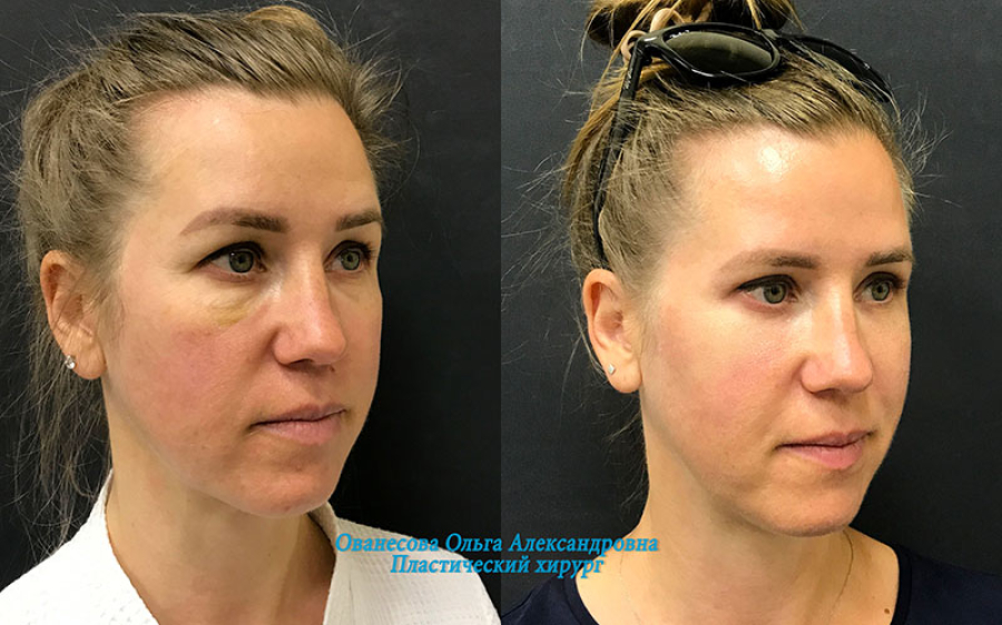 Пациентка пластического хирурга Ольги Ованесовой на фото до и после удаления малярных мешков и круговой блефаропластики