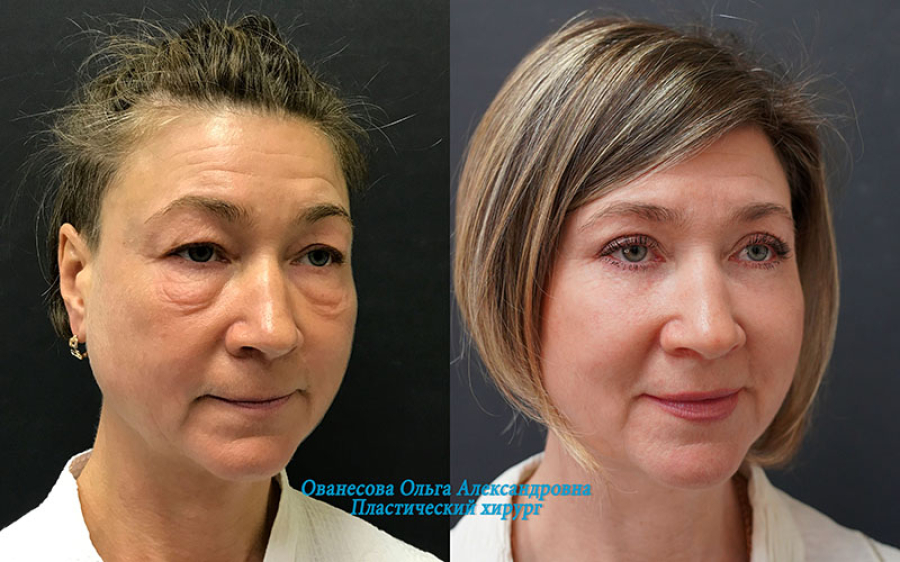 Пациентка пластического хирурга Ольги Ованесовой до и после удаления малярных мешков и круговой блефаропластики