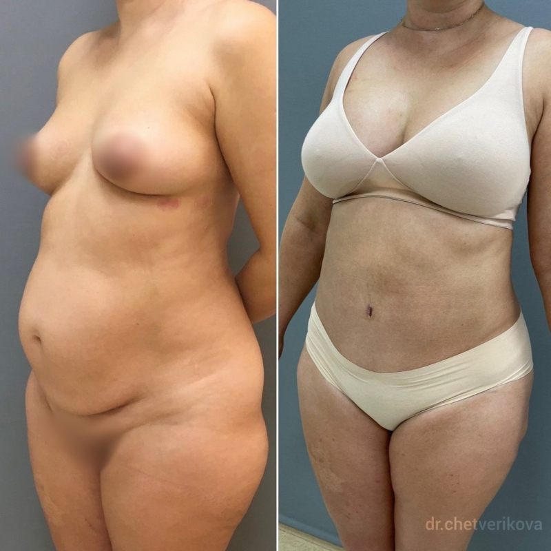 Пациентка пластического хирурга Марины Четвериковой до и после подтяжки живота и липомоделирования в СПб